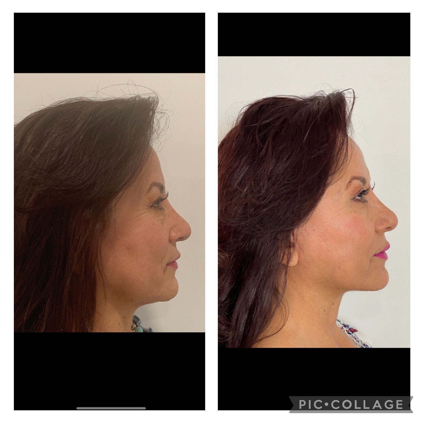 Facelift/Neck Lift Albuquerque NM, D. Eric Tuggle, D.D.S.